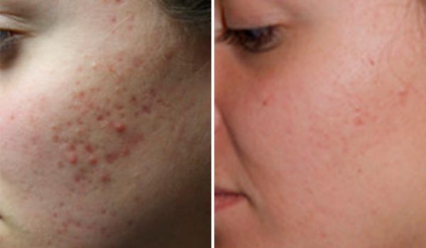 The-5-Types-of-Acne-Scars-and-How-to-Treat-Them-FT