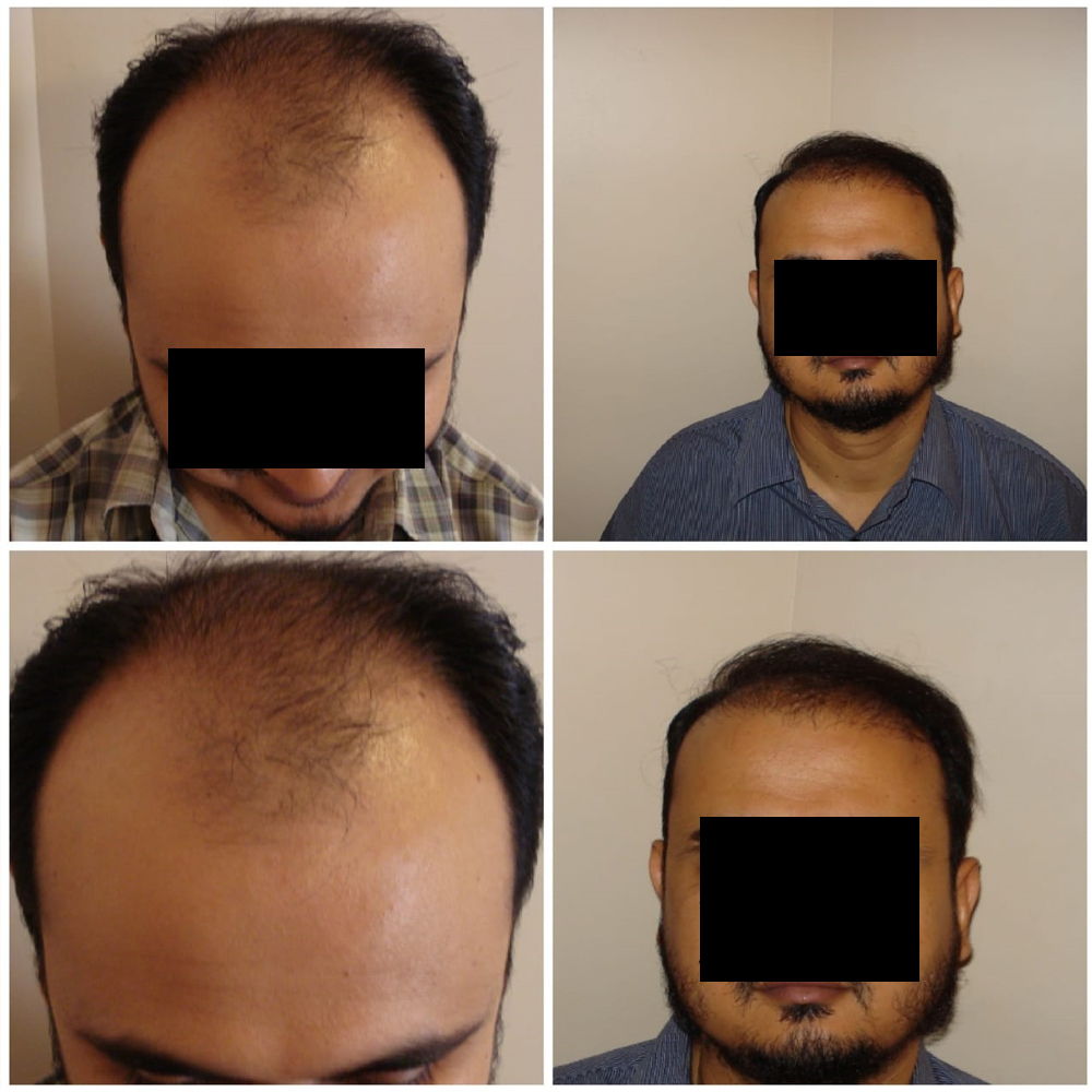 Hair Transplant in Karachi | Before After Result
