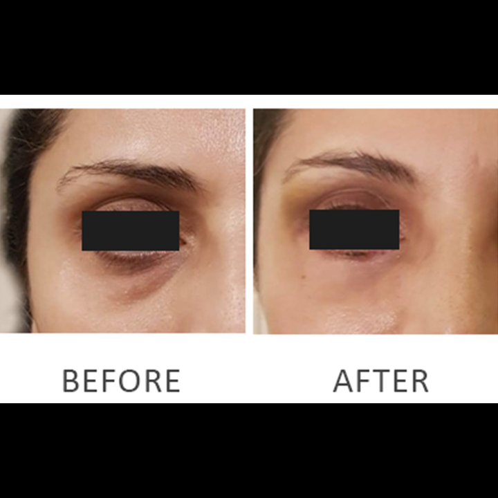 Blepharoplasty Baggy Eyelid Procedures | Before After Result