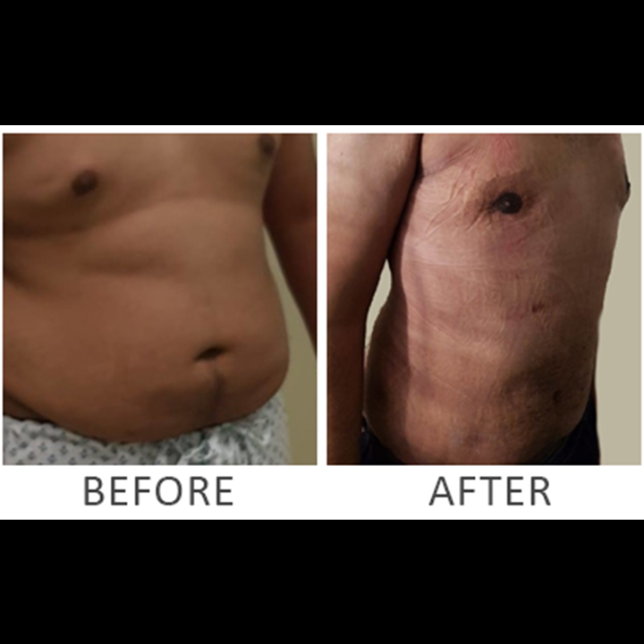 Liposuction Procedure Before/After Results