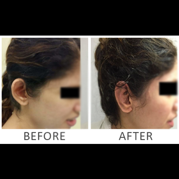 Prominent Ear Procedure | Before/After Result ​