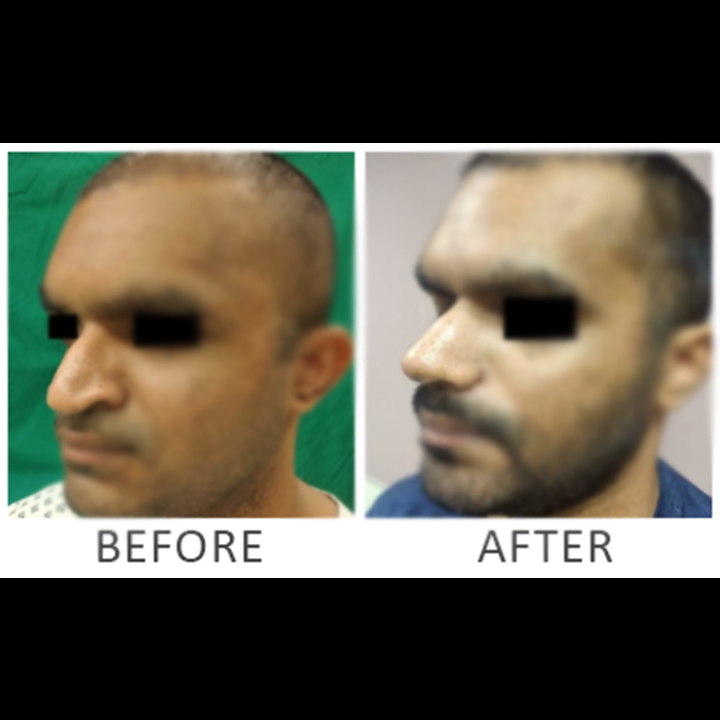Rhinoplasty Procedure | Nose job | before/after Result ​